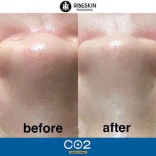 画像をギャラリービューアに読み込む, カーボキシー炭酸ガスパック(5回分)